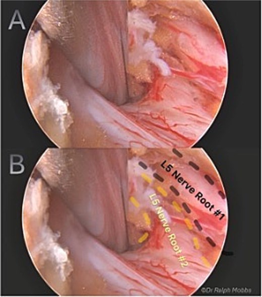Intraoperative endoscopic view of L5 nerve duplication in the L4/5 lateral recess.