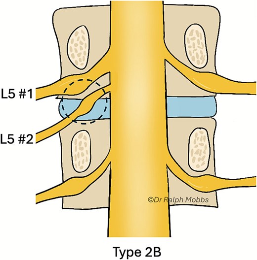 Illustration of the endoscopic view (dashed circle) for case 1, type 2B CNR.