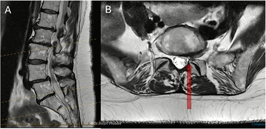 Case 2 mid-sagittal (A) and axial (B) T2-weighted MRI at L5/S1 with lateral recess stenosis (arrow).