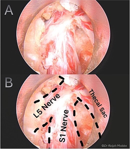 Intraoperative endoscopic view of conjoint L5 and S1 nerve root emerging from a shared dural origin.