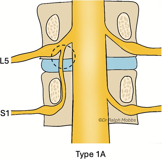 Illustration of the endoscopic view (dashed circle) for case 2, type 1A CNR.
