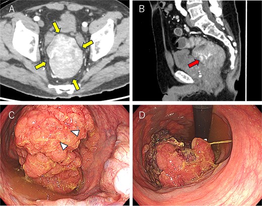 Colonoscopy and computed tomography findings. (A) A mass measuring 8.5 × 6.5 cm was observed in the lower rectum (arrow). (B) A vascular stalk-like structure was noted in the proximal portion of the tumor (arrow). (C, D) A large mass occupying the rectal lumen was observed 3 cm from the anal verge (D: retroflexed endoscopic view). The arrowhead indicates the biopsy site.
