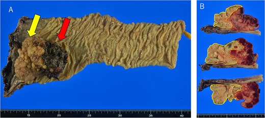 Macroscopic findings of the resected specimen. (A) A tumor measuring 8.5 × 7.0 cm protrudes into the intestinal lumen, with surface necrosis observed on the oral side (red arrow) and multiple elevated lesions on the anal side (yellow arrow). (B) Sectional images reveal a clear demarcation between the two components (red lines: neuroendocrine carcinoma; yellow lines: adenocarcinoma).