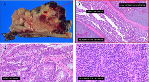 Histopathological findings of the tumor. (A) Macroscopic view of the tumor. (B) Low-magnification image (×20) showing the interface between the adenocarcinoma and neuroendocrine carcinoma components. (C) High-magnification image (×200) of the adenocarcinoma area. (D) High-magnification image (×400) of the neuroendocrine carcinoma area.