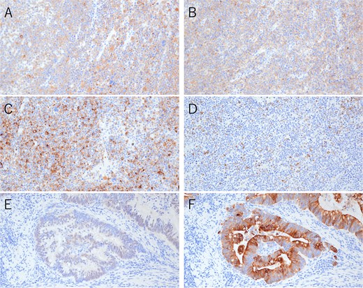 Immunohistochemical findings of the primary tumor (×200). (A) Synaptophysin staining in neuroendocrine carcinoma. (B) CD56 staining in neuroendocrine carcinoma. (C) Chromogranin A staining in neuroendocrine carcinoma. (D) CAM5.2 staining in neuroendocrine carcinoma. (E) CDX2 staining in adenocarcinoma. (F) CK20 staining in adenocarcinoma.