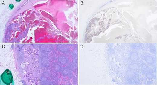 Immunohistochemical findings of metastatic lymph nodes. (A, B) Lymph node metastases showing both tubular adenocarcinoma and neuroendocrine carcinoma components, with synaptophysin staining (×40). (C, D) Lymph node metastases of tubular adenocarcinoma, with synaptophysin staining (×40).