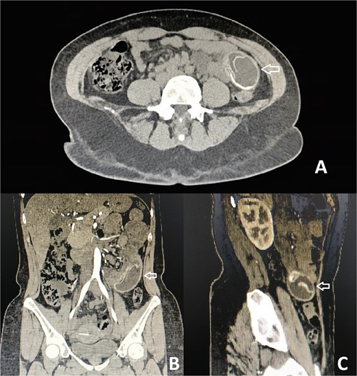 CT with evidence of a foreign body compatible with a migrated gastric balloon (indicated by the arrow). (A) Axial plane. (B) Coronal plane. (C) Sagittal plane.