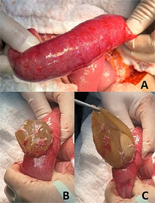 Intestinal obstruction. (A) Identification of the area of intestinal obstruction. (B) Enterectomy. (C) Removal of intraluminal foreign body (migrated gastric balloon).