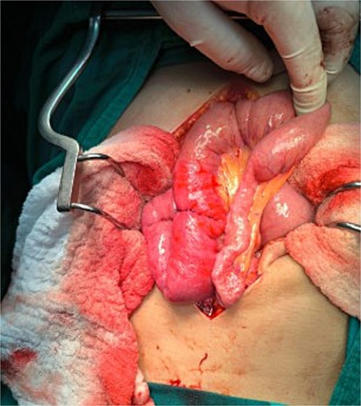 Transverse enterotomy raffia after removal of intraluminal foreign body (migrated gastric balloon).