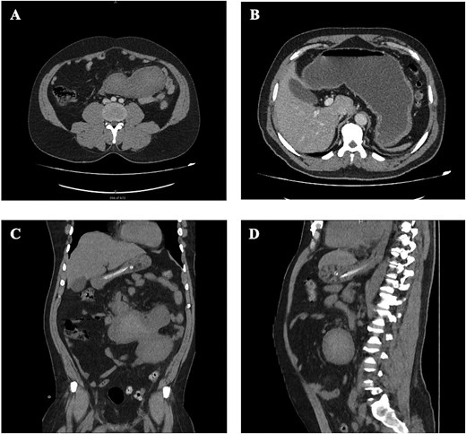 CT imaging showing intra-abdominal mass, with internal mixed high attenuation, suggestive of hemorrhagic content, and with dilatation of the stomach and proximal duodenum.