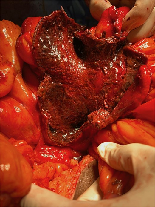 Intraoperative picture showing a large mass originating from the small bowel mesentery.