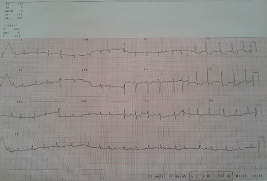 Electrocardiogram showed atrial fibrillation tachycardia.
