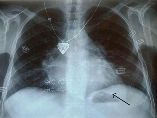Chest X ray showed pericardial calcification around heart (arrow).