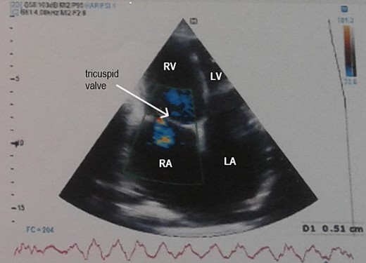 Transthoracic echocardiography showed pericardial thickening, moderate tricuspid regurgitation and biatrial dilation. RA: right atrium, RV: right ventricle, LA: left atrium, LV: left ventricle.