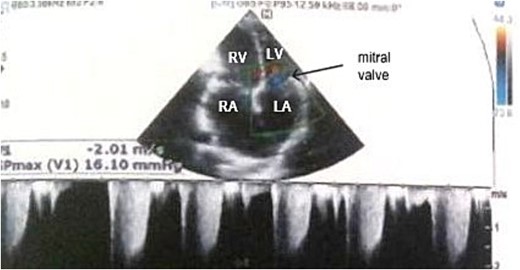 Transthoracic echocardiography showed moderate mitral regurgitation. RA: right atrium, RV: right ventricle, LA: left atrium, LV: left ventricle.