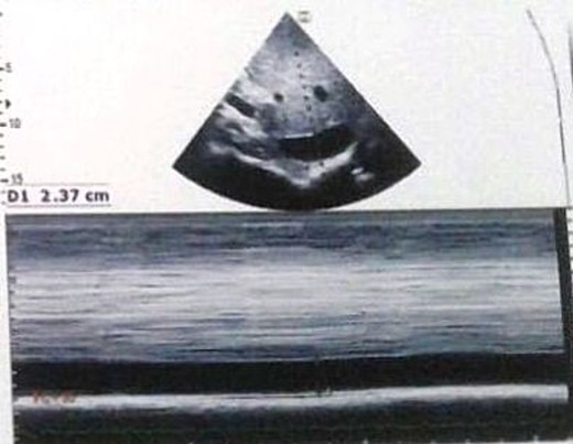 Transthoracic echocardiography showed inferior vena cava dilation.