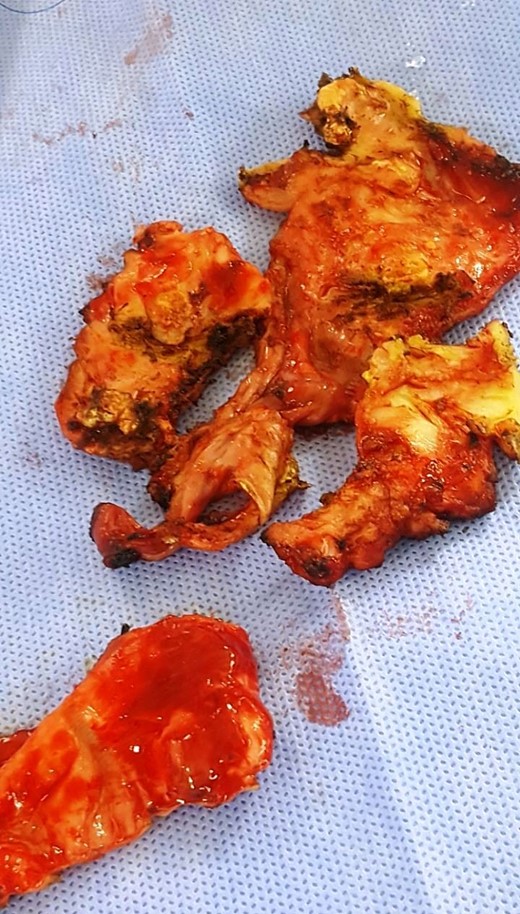 Histological specimen of pericardial tissue.