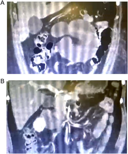 (A) Abdominal tomography showing herniation of the intestinal loops toward the space posterior to the gastrojejunostomy; (B) dilated and congested intestinal loops associated with torsion and congestion of mesenteric vessels.
