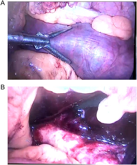(A) Intestinal loops in Petersen’s space; (B) a 70 cm segment of necrotic jejunum starting at 15 cm from the angle of Treitz.