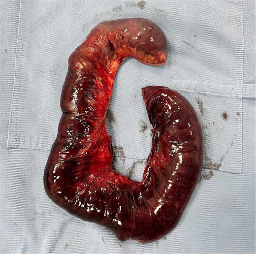 Surgical sample for pathology.