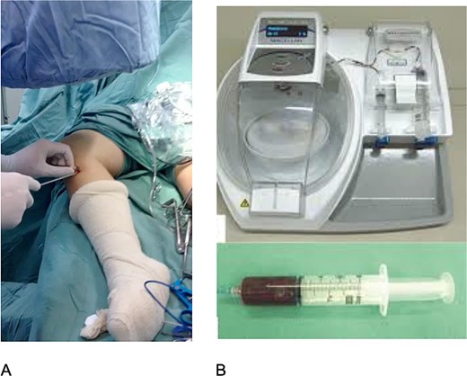 (A) STG removal under image intensifier; (B) PRP device.