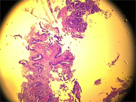 Microscopic view (×10) of pathology slide of colorectal cancer.