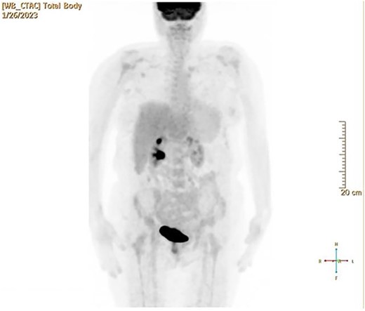 PET scan revealed multiple positive lymph nodes but no metastatic lesions in chest or abdominal organs or bone.