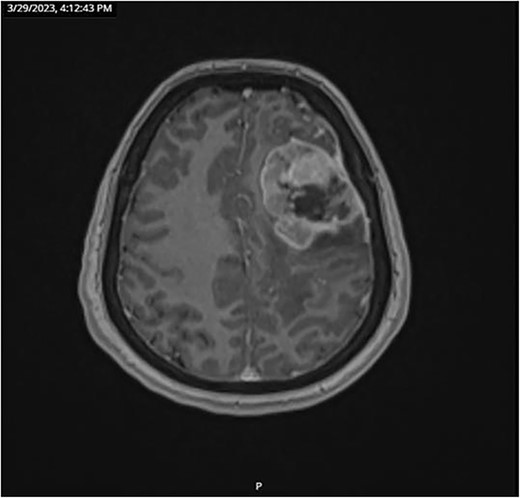 Brain MRI with gadolinium injection on 29 March 2023.