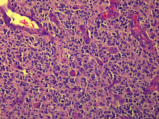 Microscopic view (×20) of pathology slide of GBM.