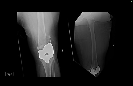 Left, acute distal periprosthetic femur fracture X-ray.