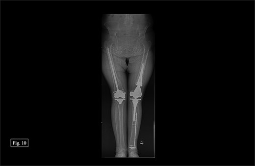 Bilateral, February 2024, full leg length X-ray.
