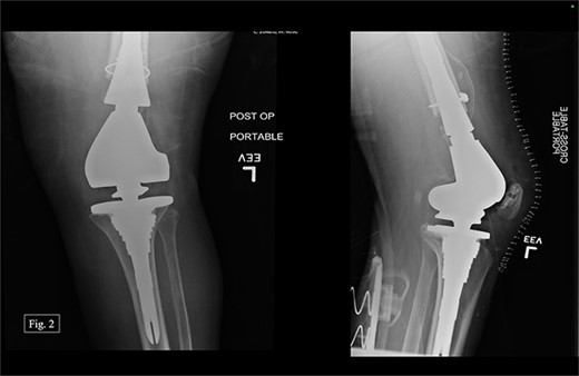 Left, immediate postoperative AP and lateral X-rays.