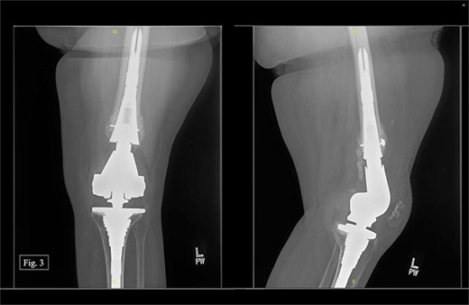 Left, 5 month postoperative AP and lateral X-rays.