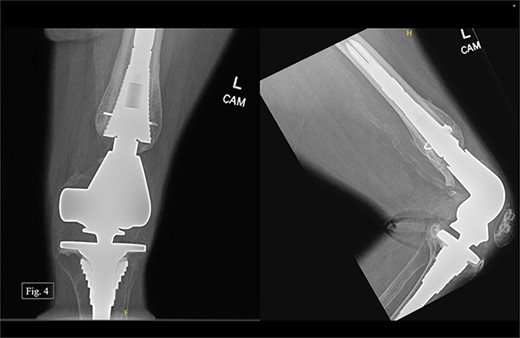 Left, 48 month postoperative AP and lateral X-rays.