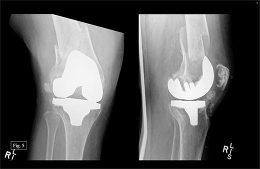 Right, acute distal periprosthetic femur fracture X-rays.