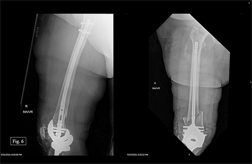 Right, immediate postoperative AP and lateral X-rays.