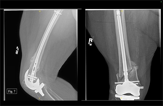 Right, 3 month postoperative AP and lateral X-rays.