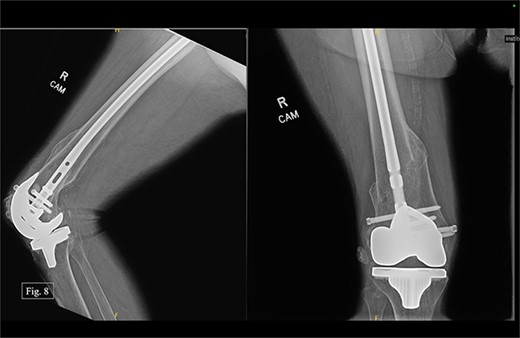 Right, 17 month postoperative AP and lateral X-rays.