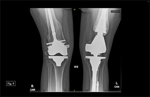Bilateral, February 2024, AP X-ray.