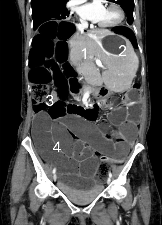 CT scan at the 6th postoperative day after hepatectomy showing cecal volvulus with: (1) Remnant liver, (2) benign liver cyst, (3) small bowel feces sign, and (4) fluid-filled dilated small bowel.