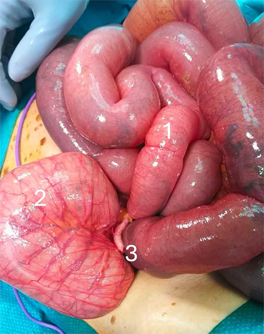Intraoperative photo showing the cecal volvulus with: (1) distended small bowel due to mechanical bowel obstruction, (2) rotated and distended cecum, and (3) appendix.