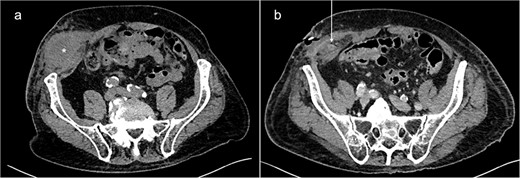 Abdominal CT-scans on initial presentation (a) and day 5 (b). A large fluid collection (*) can be seen in the right lower abdominal wall. After drainage, the appendix (white arrow) could be identified inside the abscess cavity, indicating the existence of a PVH.