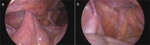 Intraoperative view on the hernia orifice containing terminal ileum (a) and the appendix (b).