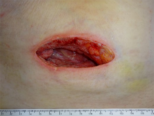 The abscess wound 2 days after application of a negative-pressure wound therapy device.