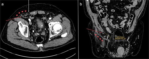 Abdominal CT-scan conducted 2 years earlier on the same patient, axial (a) and coronal (b) slices. The appendix (red arrow) is passing directly through the transversus abdominis and internal oblique muscles into the hernia sac (red triangles). The orifice is located ⁓4 cm superolateral to the right internal inguinal orifice (yellow line). *: rectus abdominis muscle; white arrow: Spigelian aponeurosis.