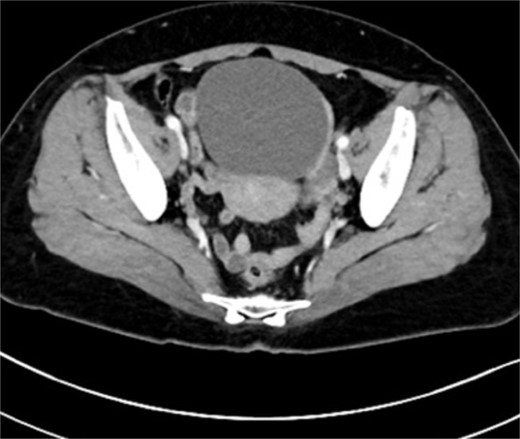 Pelvic computed tomography image: A large mass occupying the pelvis which is a 10 cm sized cystic mass.