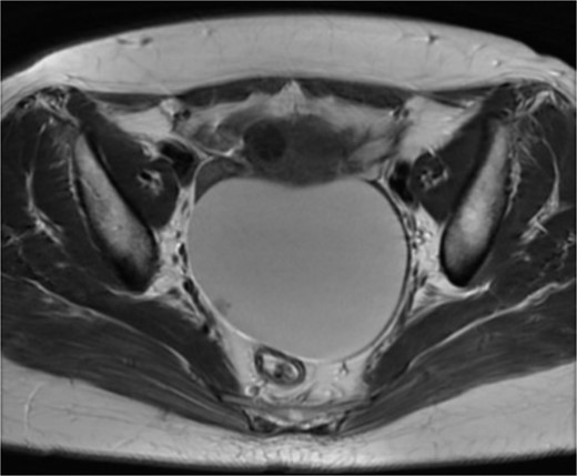 Magnetic resonance imaging: 10 cm sized cystic mass a solid part (arrow) in the pelvis.