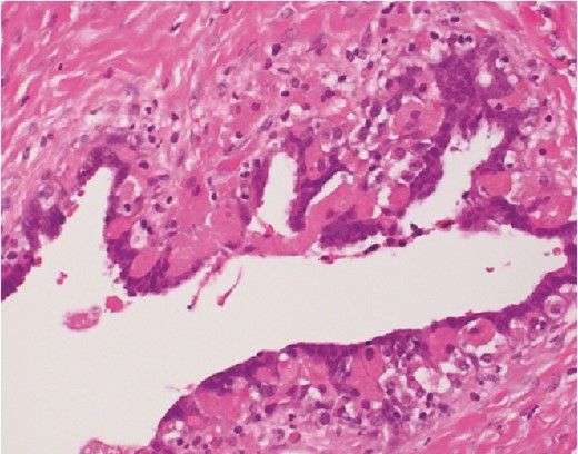 Micro-photograph of paraovarian cyst (H&E, ×200).