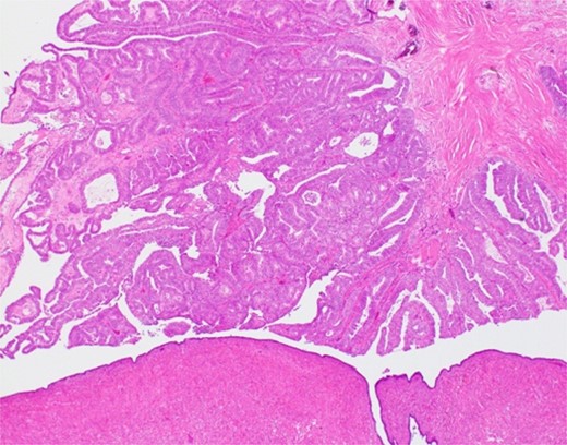 Endometrioid carcinoma (H&E, ×40).