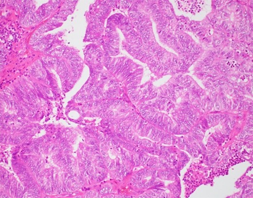 Endometrioid carcinoma (H&E, ×200).